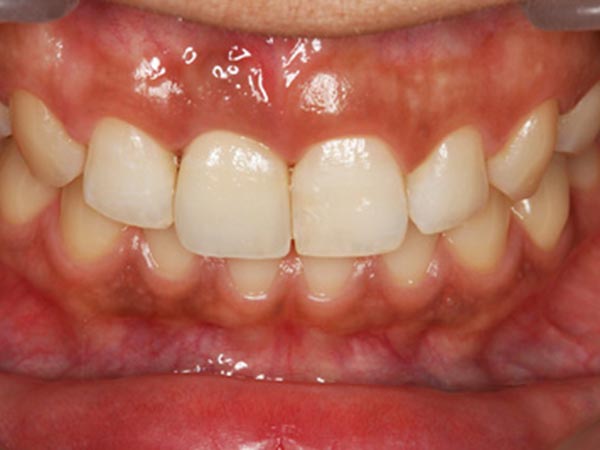 前歯のインプラント治療2 After