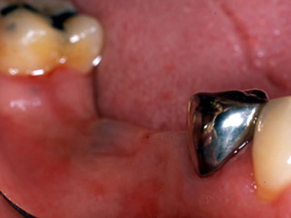 奥歯（臼歯）のインプラント治療　横から見た症例 Before