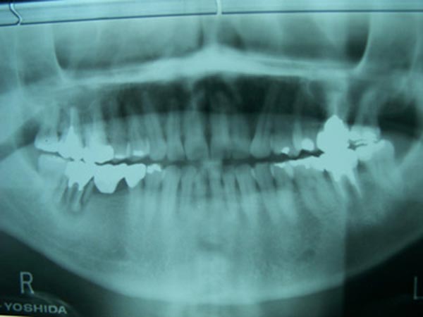 奥歯（臼歯）のインプラント治療　レントゲン写真 Before