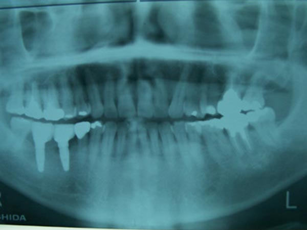 奥歯（臼歯）のインプラント治療　レントゲン写真 After
